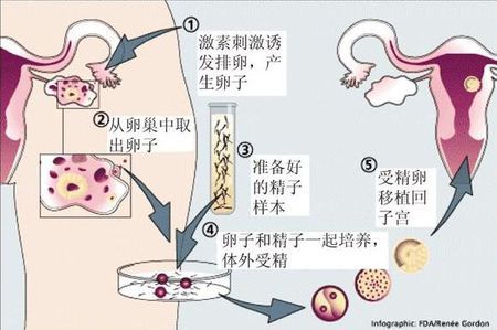 无精症案例